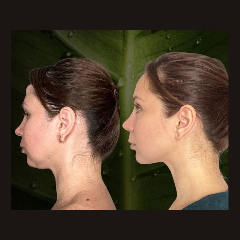 Facial sculpting in profile — before and after a course