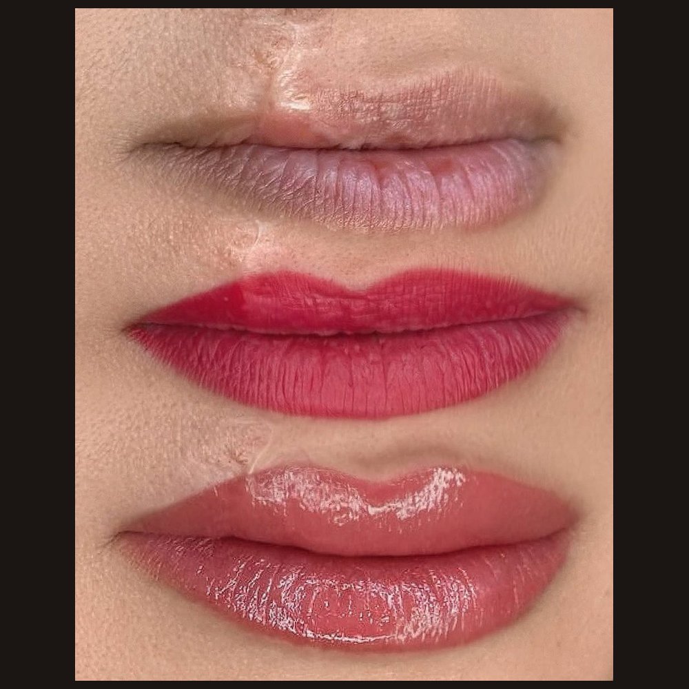 Lip contour restoration in a signature technique — the client had lost part of her lip after a dog bite